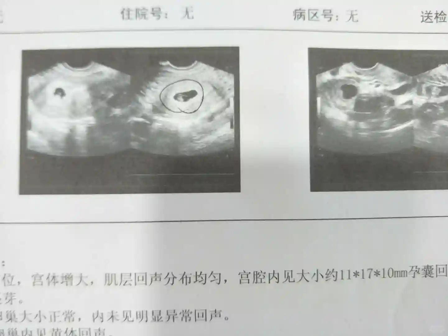 卵巢早衰成功自怀经历分享与供卵助孕机构推荐